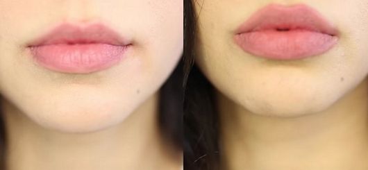 pmd-kiss-before-after